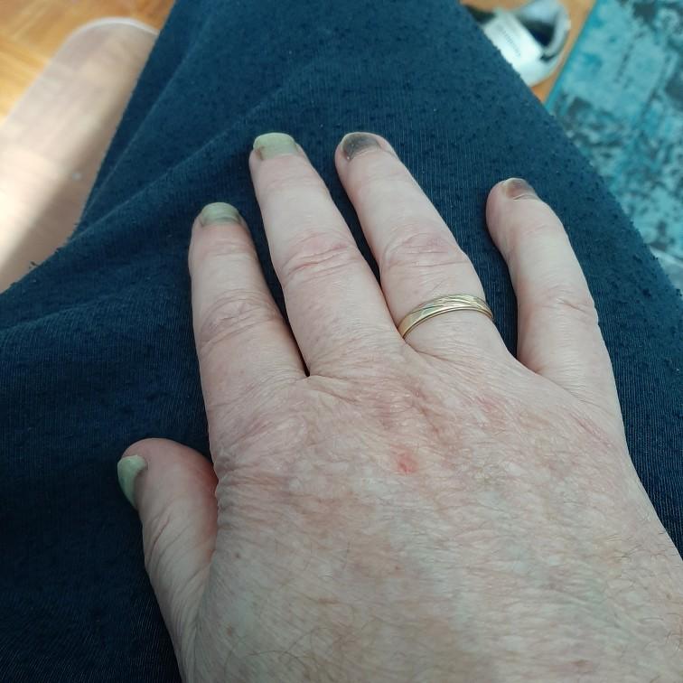 Mijn nagels, bijna 2 maanden na de laatste chemo....