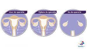 Baarmoeder verwijdering