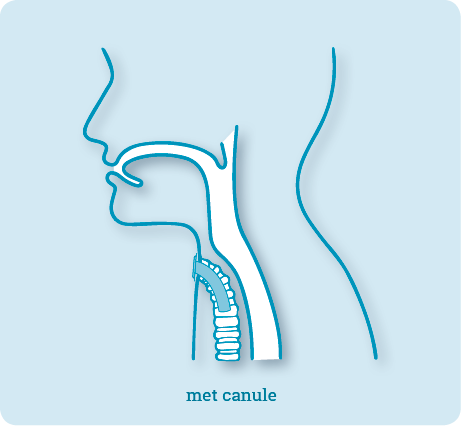 Tracheostoma met canule