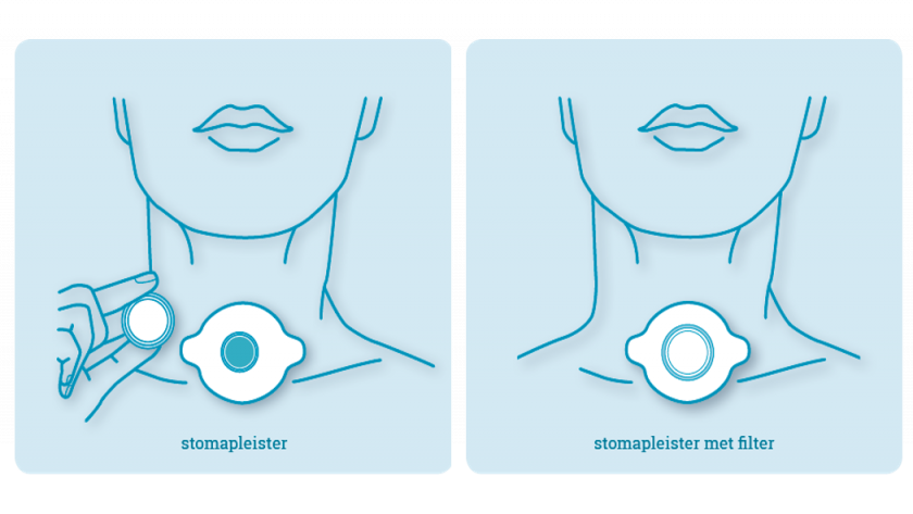 Stomapleister voor het tracheostoma